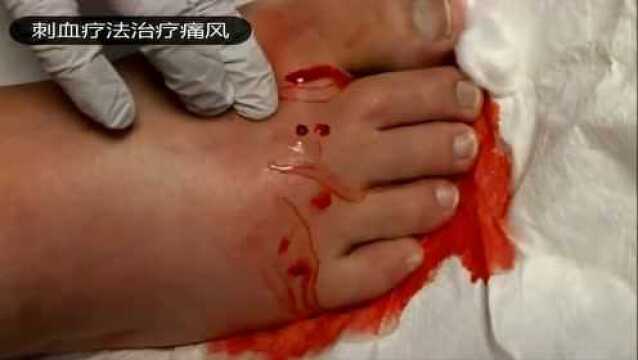 刺血放血疗法治疗痛风脚肿