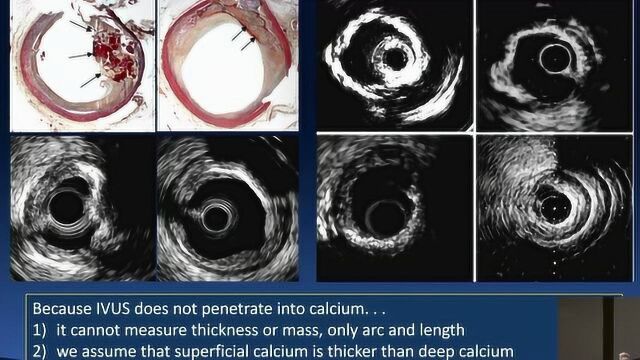华医心诚医生集团讲堂:刘健教授“钙化病变影像学评估的重要性”