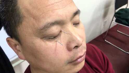 中医手法张秀春针灸治疗近视集锦视频教程