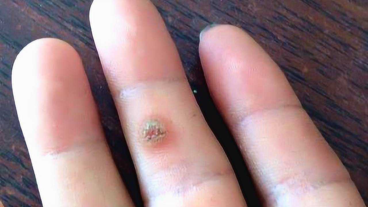 将手上的瘊子切开,在显微镜下放大500倍能观察到啥?看完心情复杂