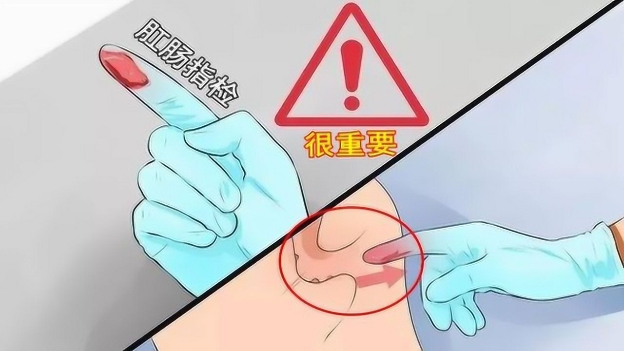 因为尴尬，体检时不做肛肠指检？医生：它的重要性您先看看！_高清