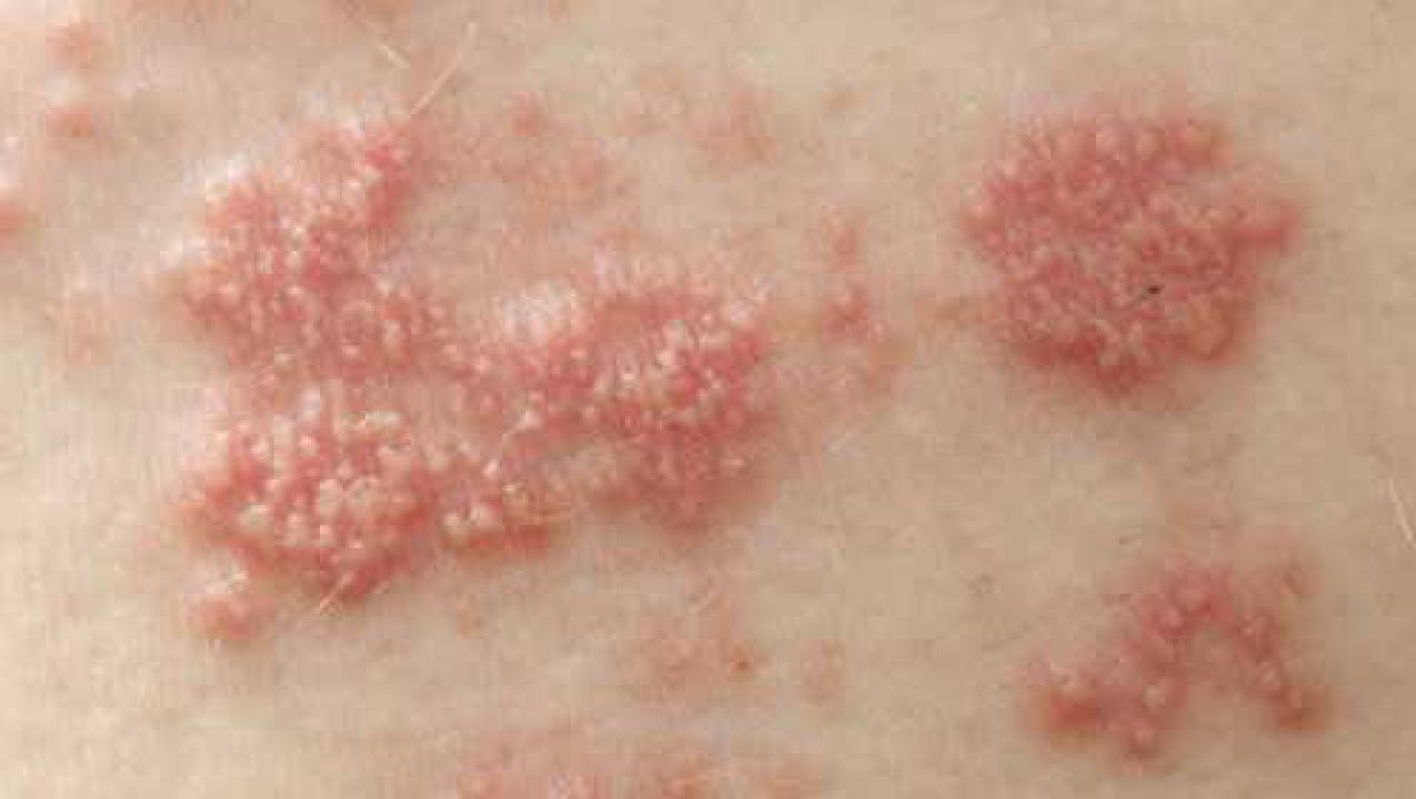 致命的皮肤病缠腰龙缠一圈真的会要命吗医生给出了答案