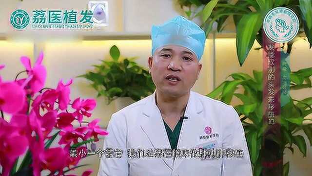 广州植发医院医生解释别人头发能否移植