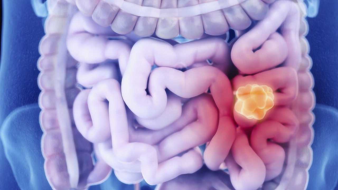 男子凌晨肠癌离世,提醒:排便出现3个"异常",当心肠道已癌变