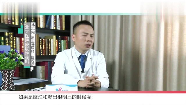 用药百科什么情况下不能使用酮康唑乳膏