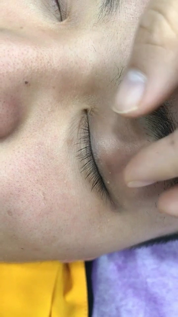 正确扒眼皮方法