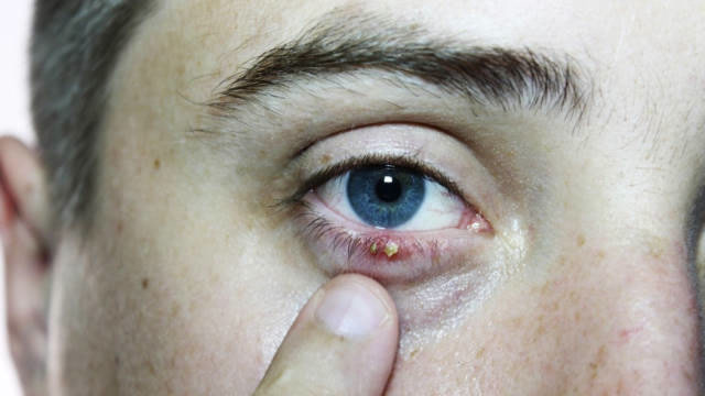 眼睛里也会"长结石"?这5类人更易患上这病,看看你在不在其中