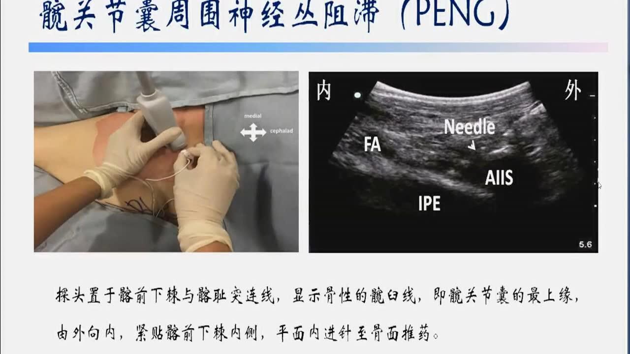 第270讲:超声引导髂筋膜阻滞应用与研究进展(杨曙光)