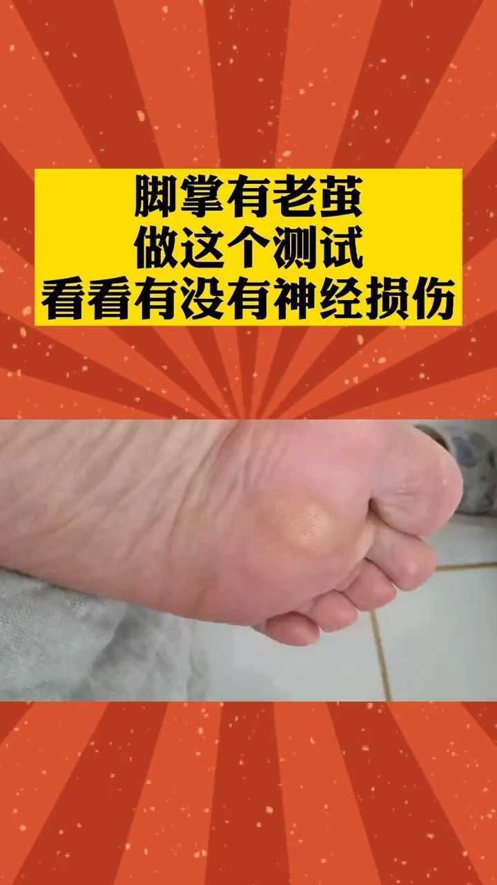 腳掌有老繭自己做個測試看疼不疼橫弓塌陷健康