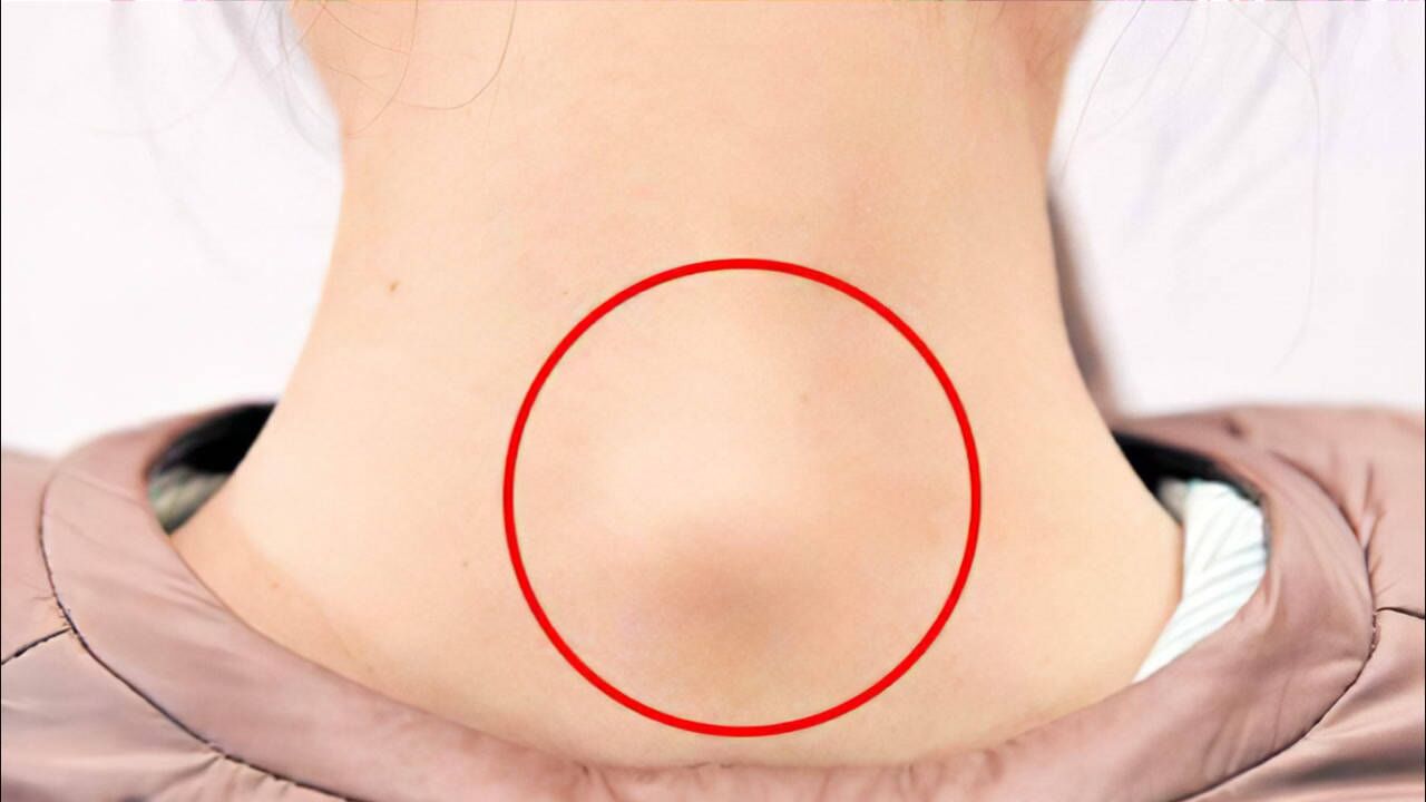 富贵包="夺命"包,这三个动作帮您缓解颈椎问题!