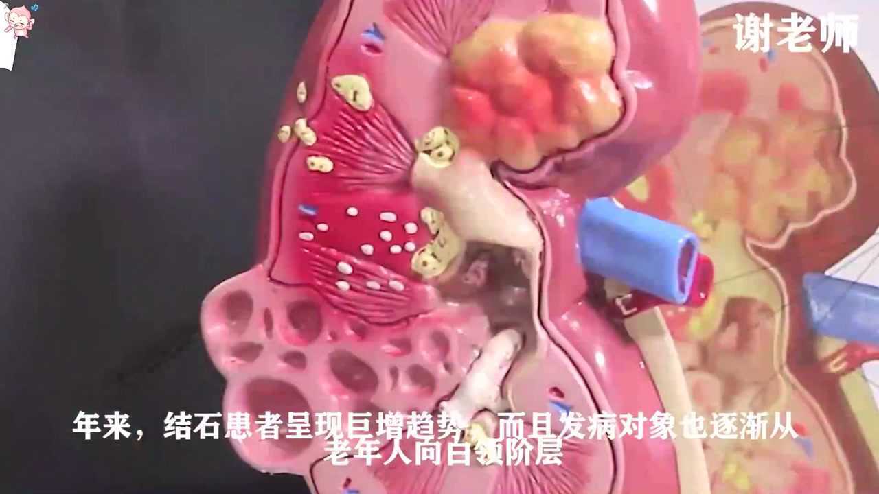 腎結石怎樣立馬止疼腎結石吃什麼藥可以排石腎結石操做法視頻