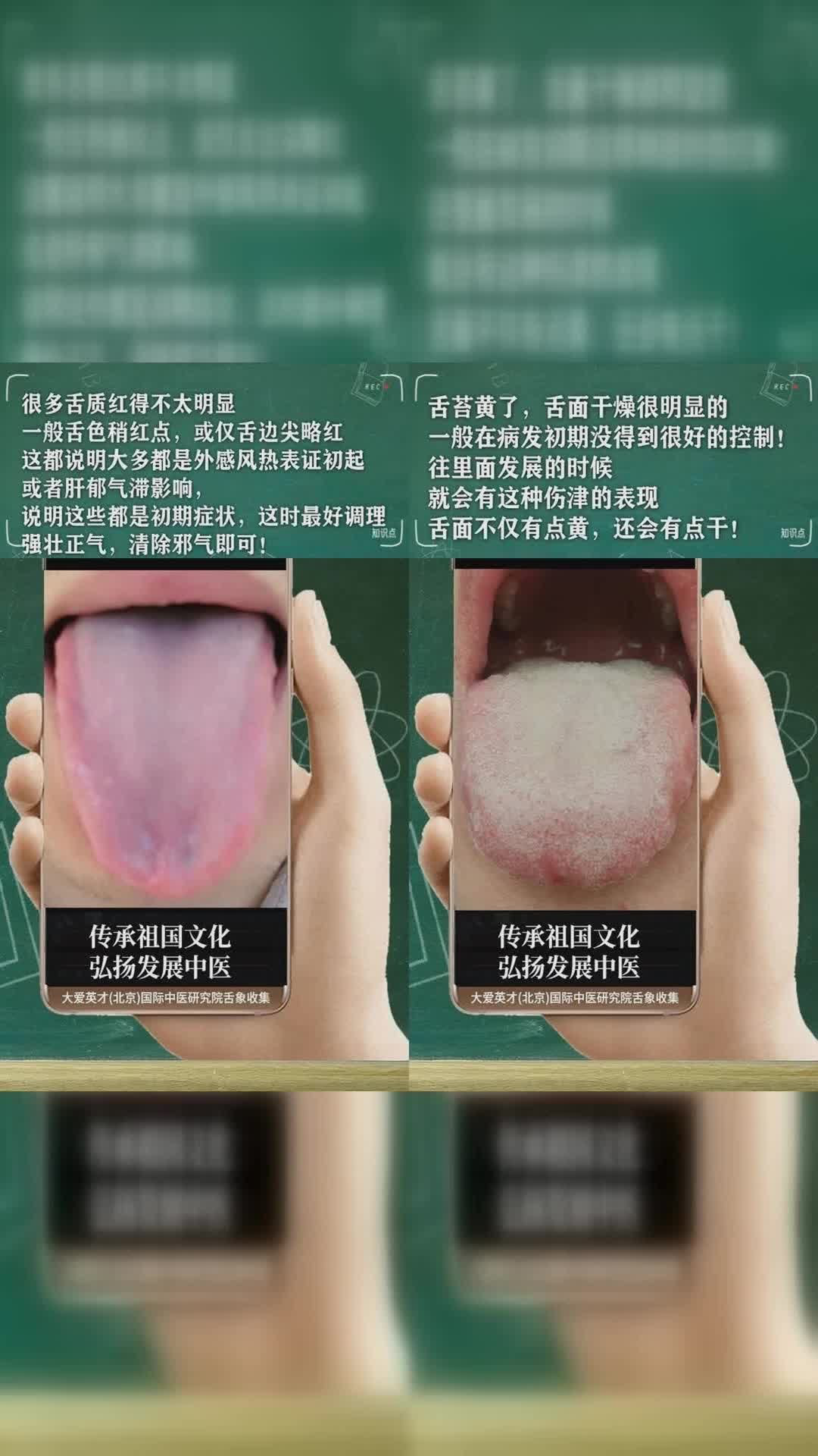 研究舌象:外感寒溼舌,相火逆升,肺不能斂,清陽不能上升