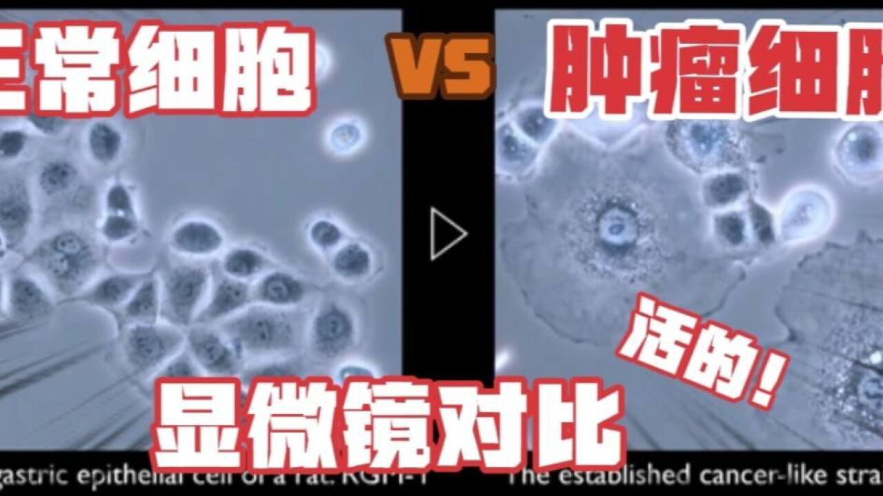 震撼！正常细胞和“癌肿瘤细胞”究竟有什么区别？！_高清1080P在线观看平台_腾讯视频