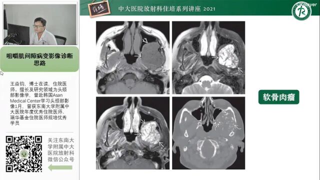 咀嚼肌间隙病变的影像诊断思路中大王焱均