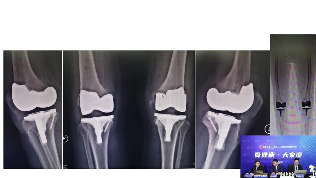 赛灵药业“骨健康ⷥ䧥𐈢€直播间|骨科真实病例分析