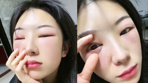 女子感染新冠持续高烧疼痛,哭到眼睛睁不开,隔天浮肿自嘲变猪头