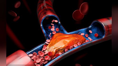 人体哪些部位的血管易形成”血栓？生活中如何预防血栓？