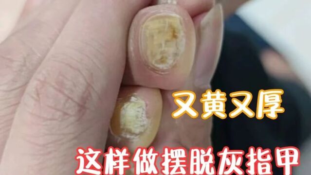 白醋也能去除灰指甲?!过来人亲测有效的祛灰方法,快去试试吧!