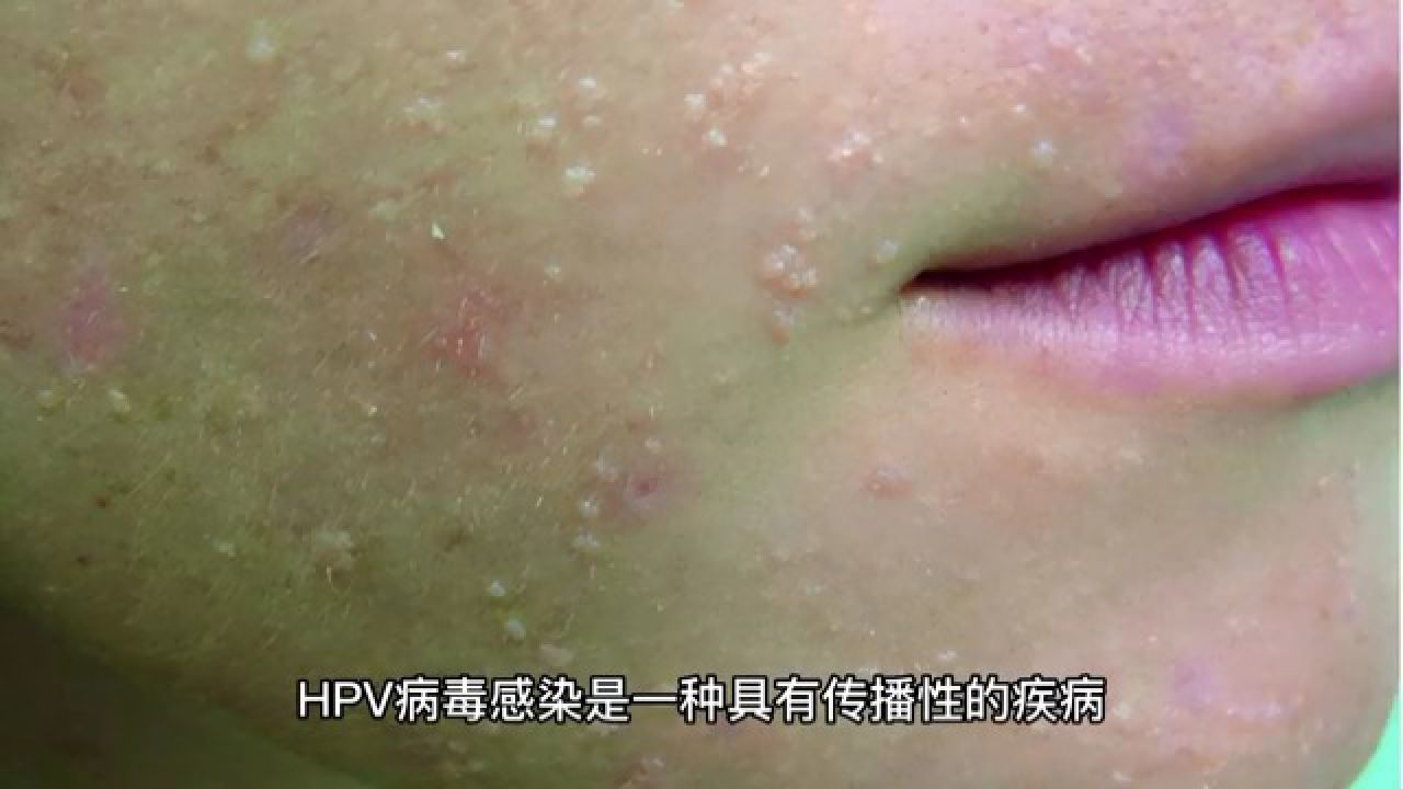 hpv病毒感染是传播性疾病 南京华肤医院