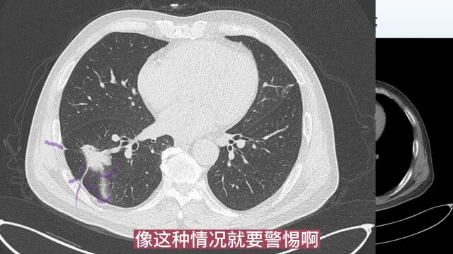 看1个混合磨玻璃,是肺癌,2个细节提示转移机会大