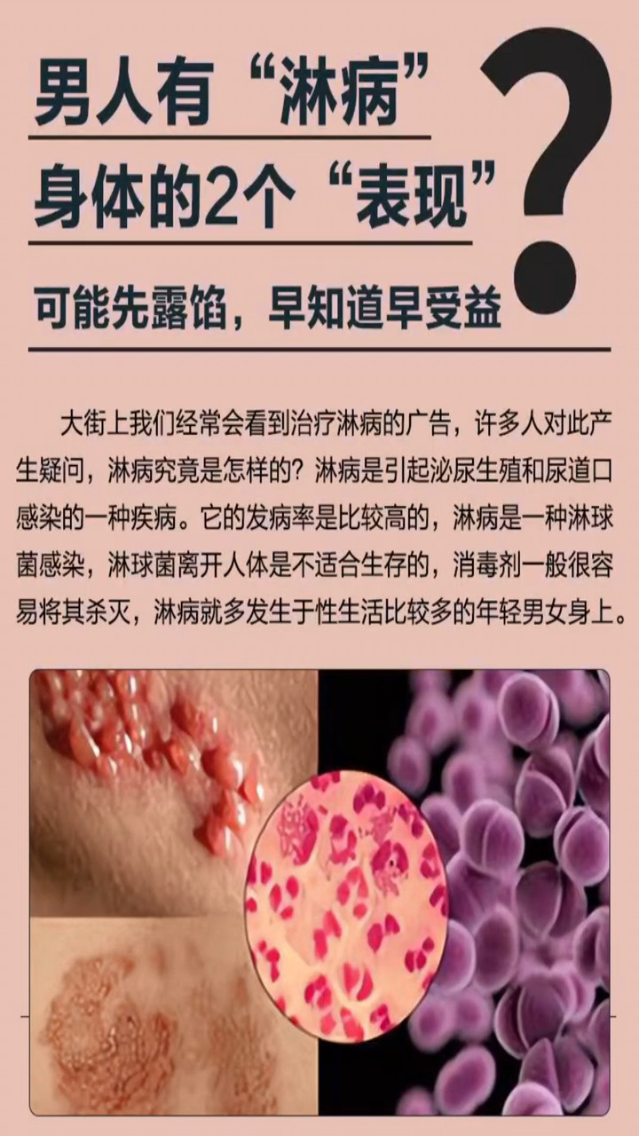 男人有淋病,身体的表现是什么 南京华肤医院