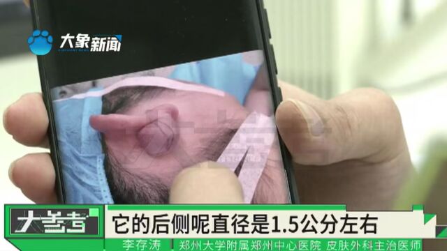 女子耳朵后侧长1.5公分大“肉球”,竟是因为打耳洞导致的?医生:每周都会有这样的病人