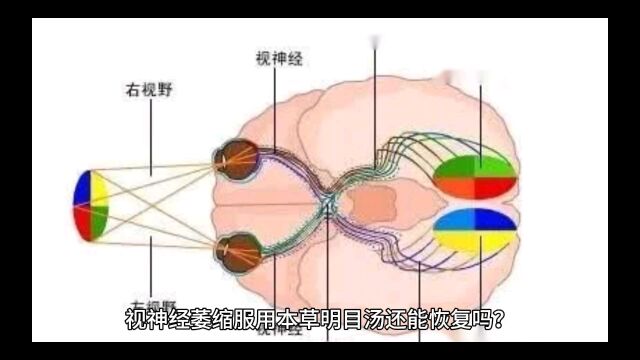 视神经萎缩服用本草明目汤还能恢复吗?