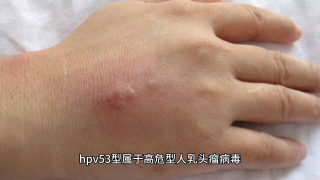 hpv53阳性是什么南京家和医院