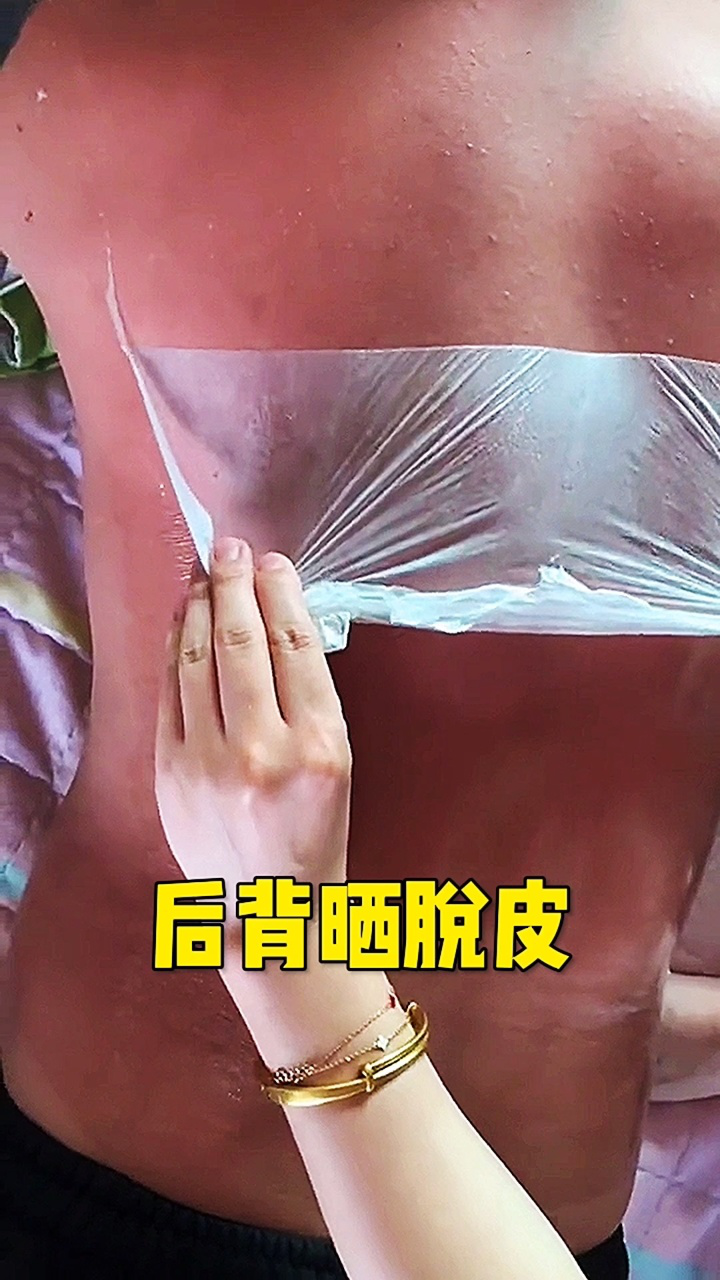 后背晒脱皮