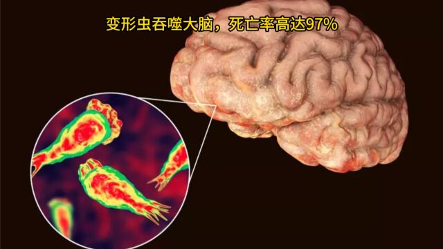 变形虫吞噬大脑,死亡率高达97%