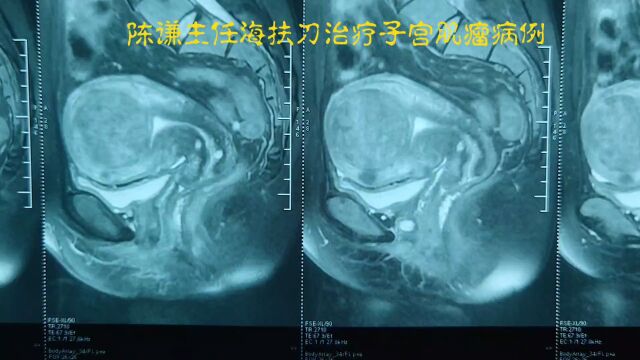 血流丰富子宫肌瘤海扶刀治疗病例