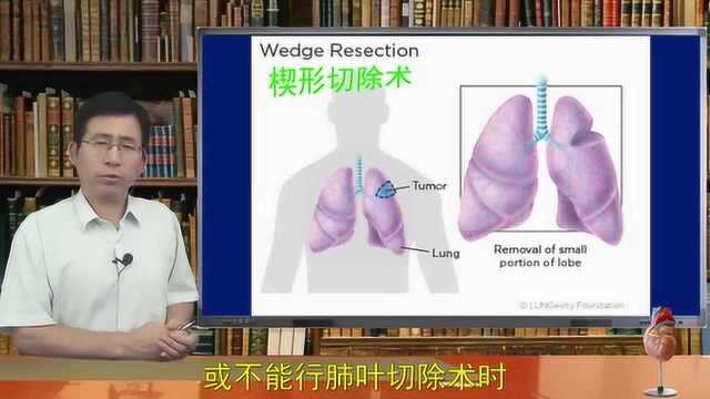 肺癌手术型全肺切除如何呼吸?肺叶切除楔形切除节段切除袖状切除