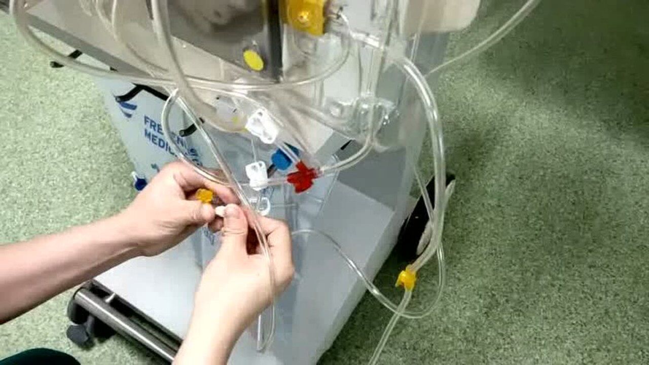 费森CRRT治疗操作_高清1080P在线观看平台_腾讯视频