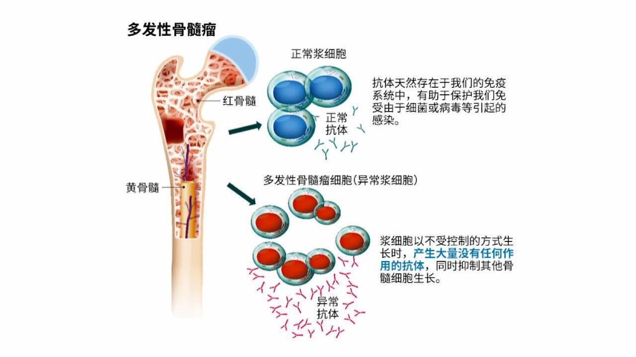 多发性骨髓瘤7.