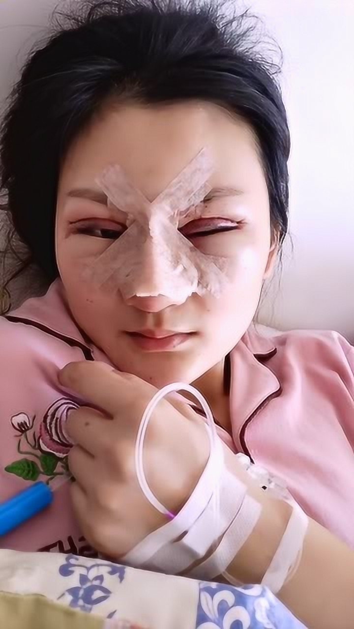 花18万整容脸肿成这样真是花钱找罪受啊