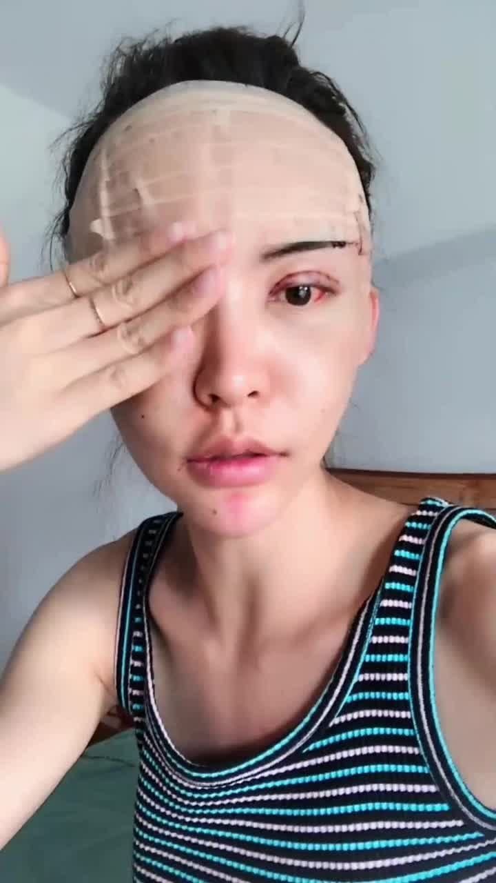 这就是整容后的恐怖这脸肿的不忍直视看她的样子就感觉害怕