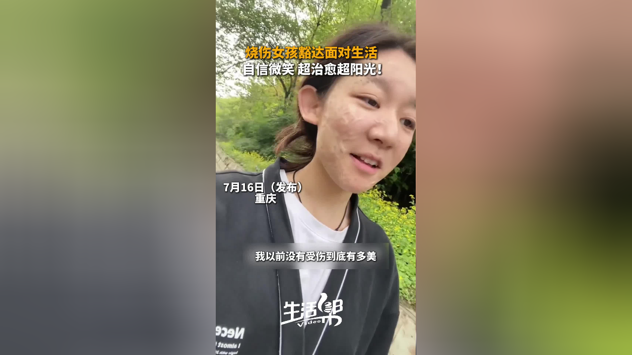 烧伤女孩豁达面对生活 温暖的笑容治愈网友