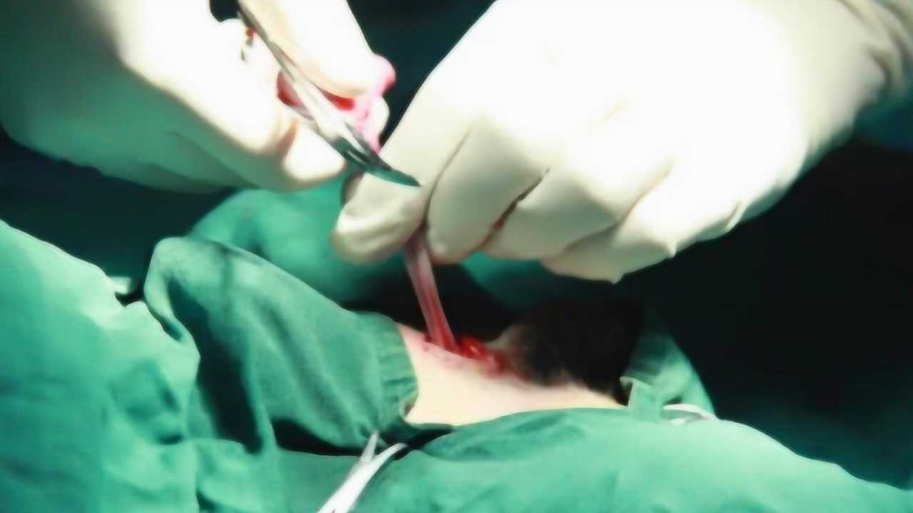 男性结扎手术是怎么做的别不好意思看成年人该明白