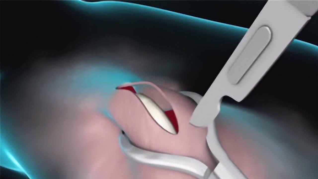 男性做"结扎手术"会怎么样?3d动画演示全过程,看完后背一凉!_腾讯视频