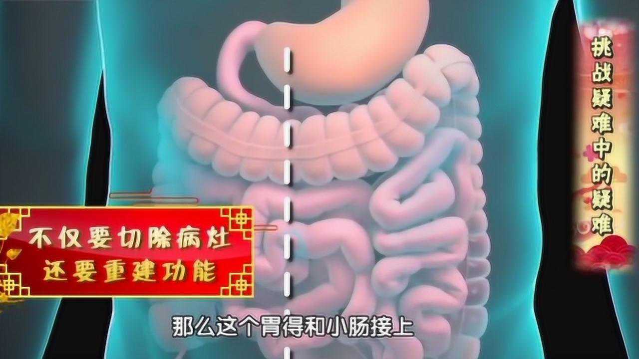 揭秘肠镜：跟着医生看，做肠镜的全过程，及肠息肉切除手术！_高清