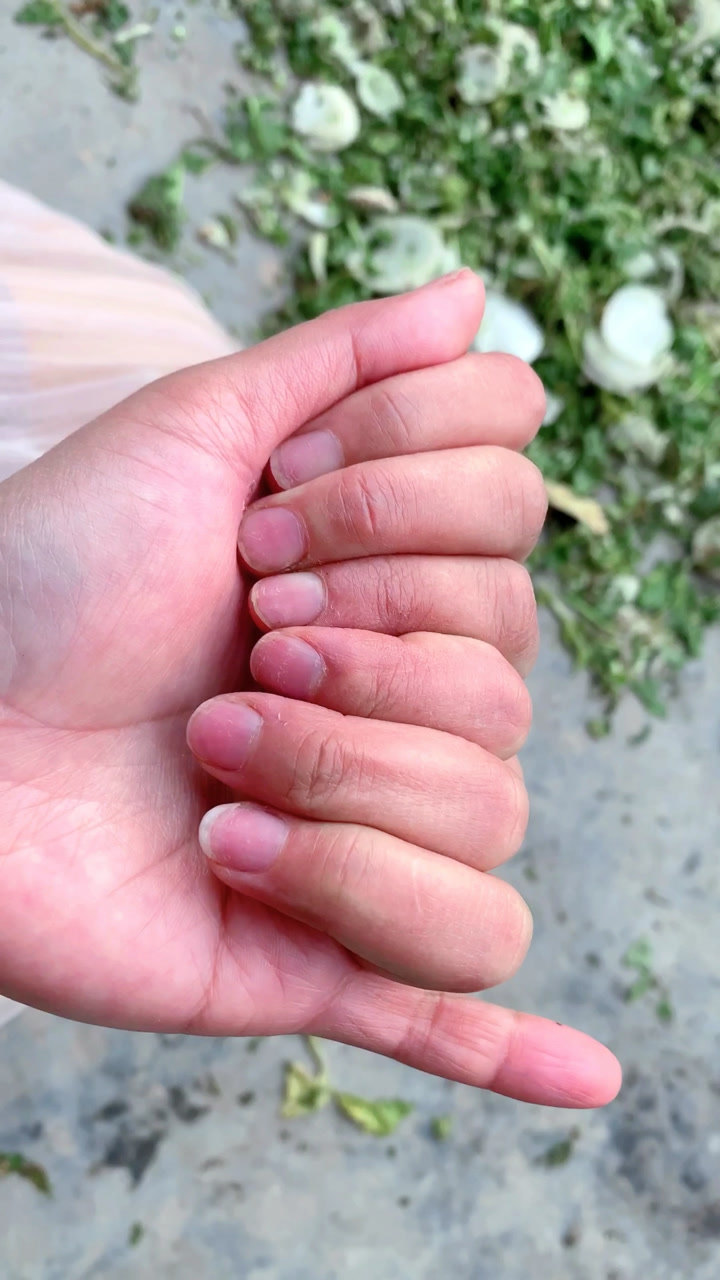 一只手掌八根手指,你们见过吗?