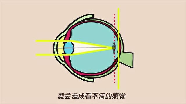 孩子戴眼镜时间长了眼球突出该怎么办?专家给出这个解决方案,家长必看!