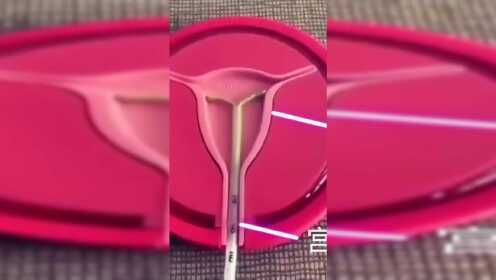 介:示意图告诉你,节育环怎么放进去的0:00:22螺栓球网架节点安装示意