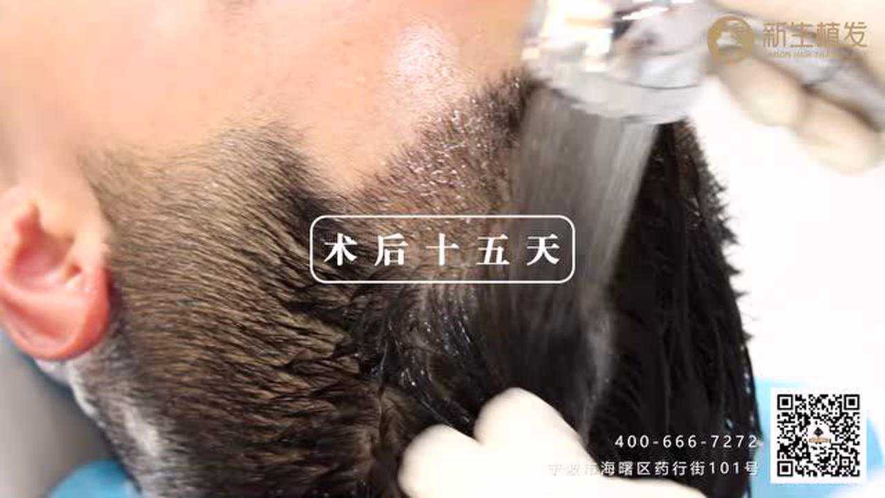 长沙有哪些植发选新生3d植发(长沙有哪些植发选新生3d植发的医院)