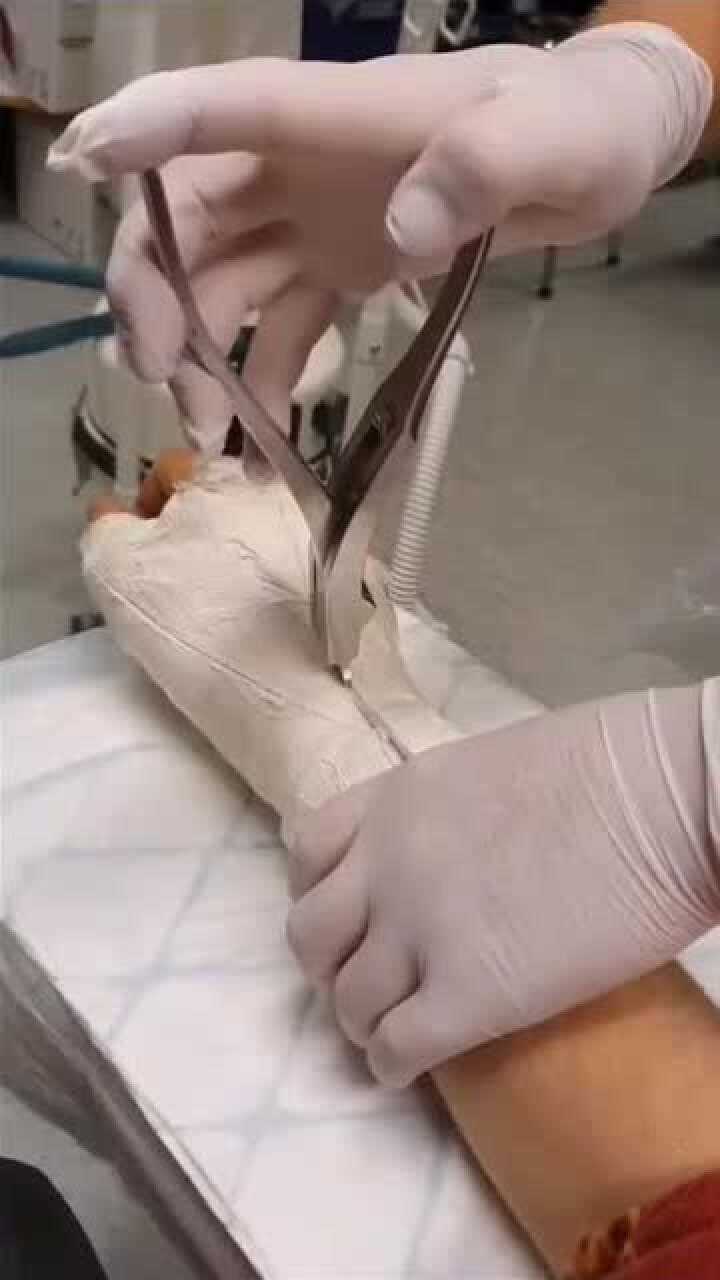 带你看看是怎么拆石膏的