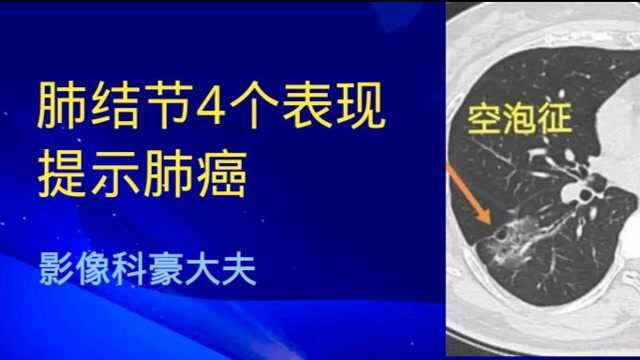 磨玻璃肺结节,这4个CT表现提示肺癌,要尽早手术