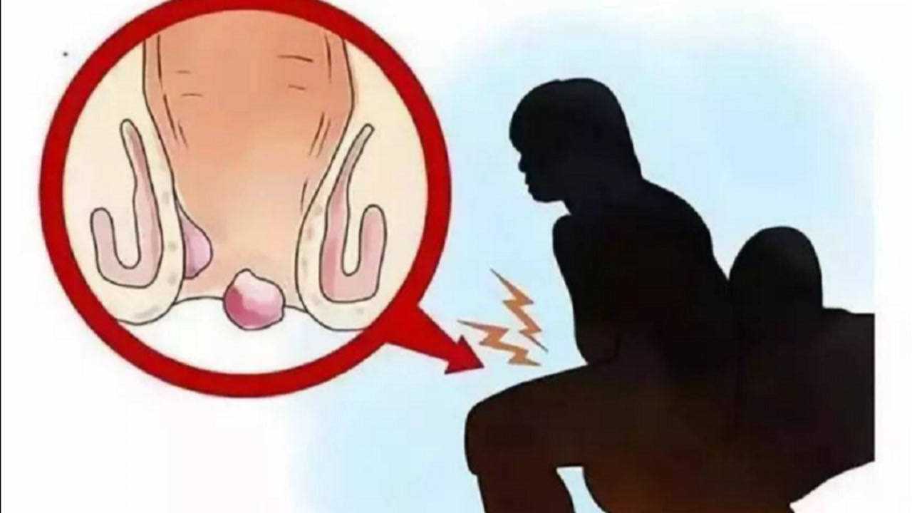 肛门外长了个软软的肉疙瘩摸起来不痛不痒的是痔疮吗