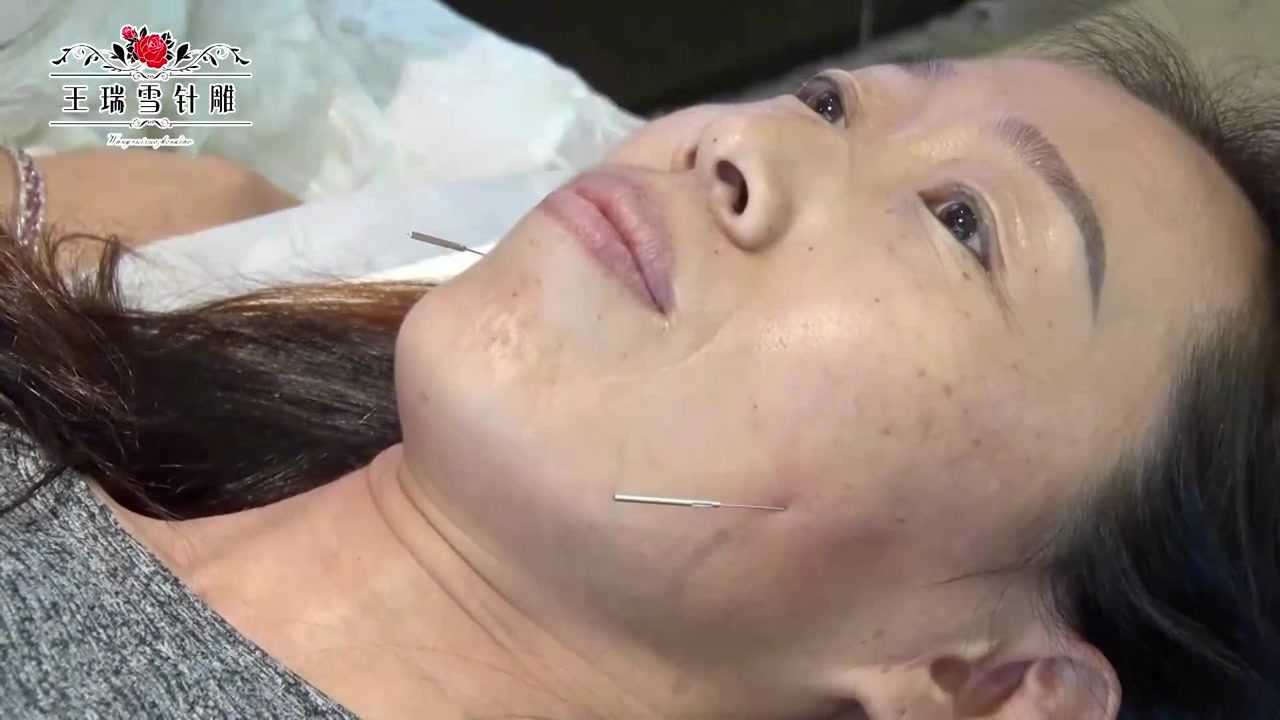 美容养颜就这么简单中医针灸塑形鼻宫凹陷川字纹隆鼻一次解决