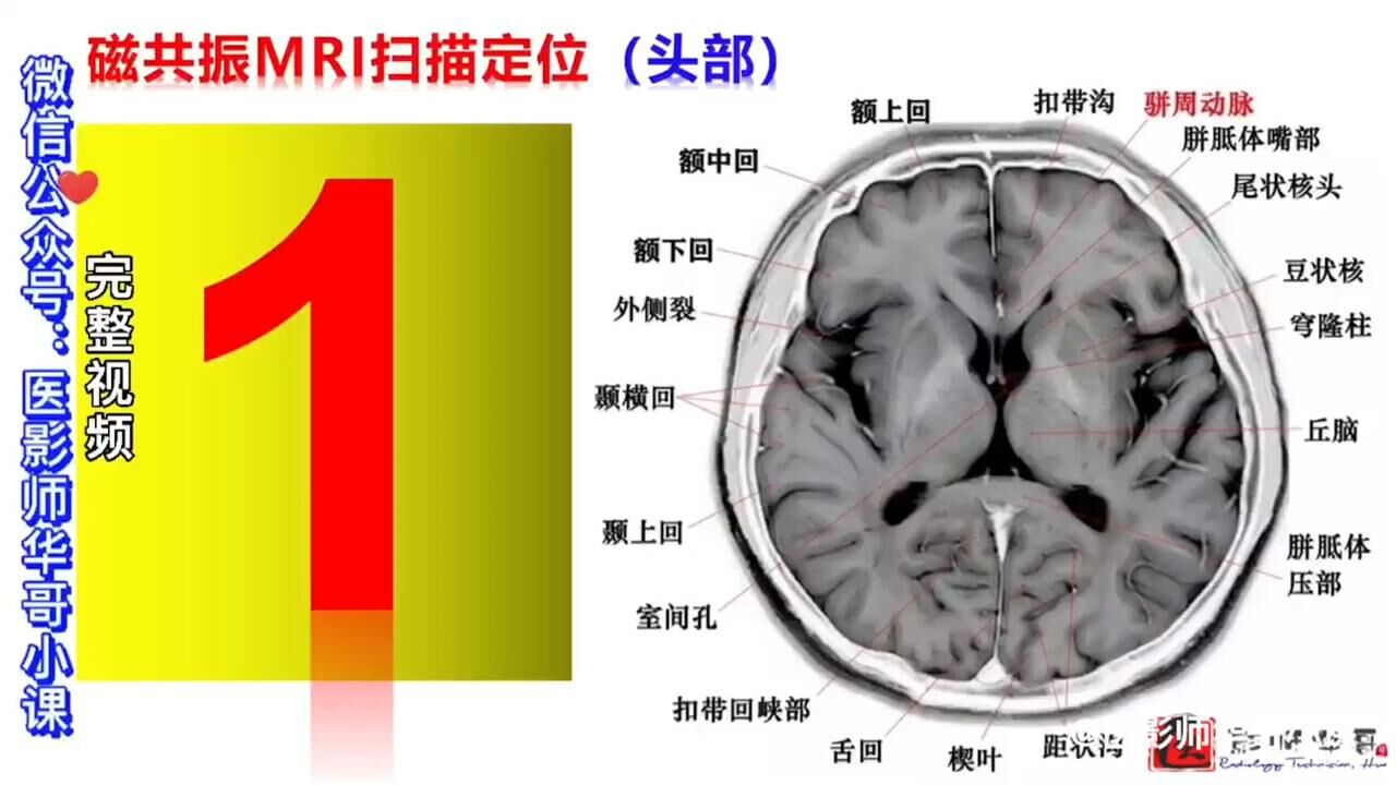 头颅磁共振mri扫描定位线