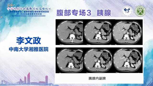 胰腺疾病影像分析思路中南大学湘雅医院李文政